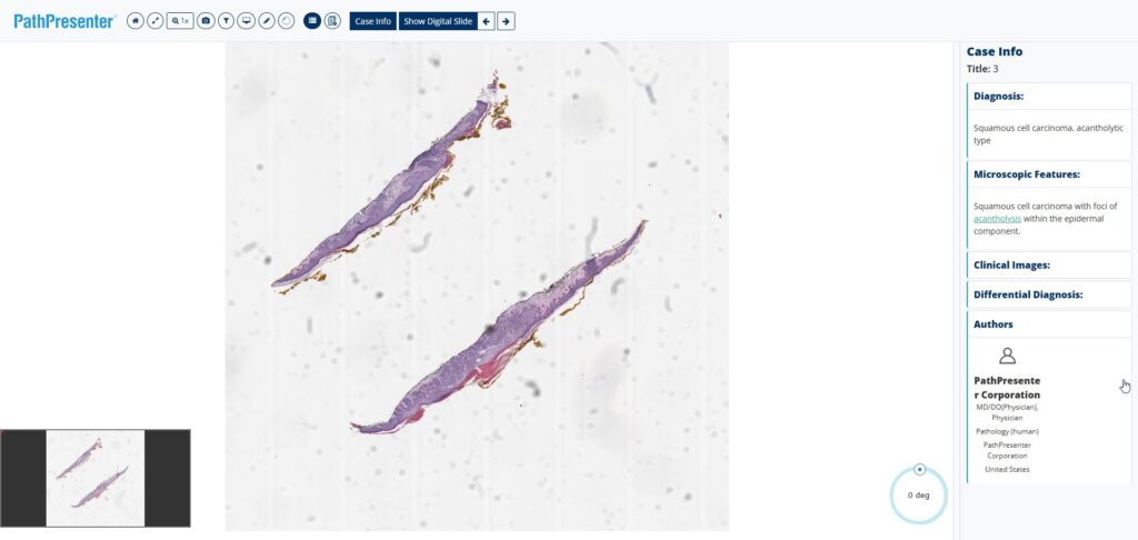 Squamous cell carcinoma, acantholytic type, whole slide image in PathPresenter 
