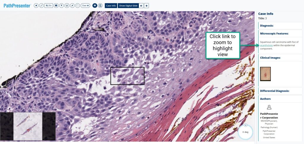 Squamous cell carcinoma with foci of acantholysis within the epidermal component