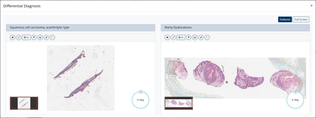 Squamous cell carcinoma, acantholytic type vs warty dyskeratoma
