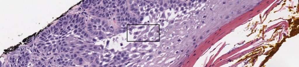 Squamous Cell Carcinoma - Acantholysis highlighted